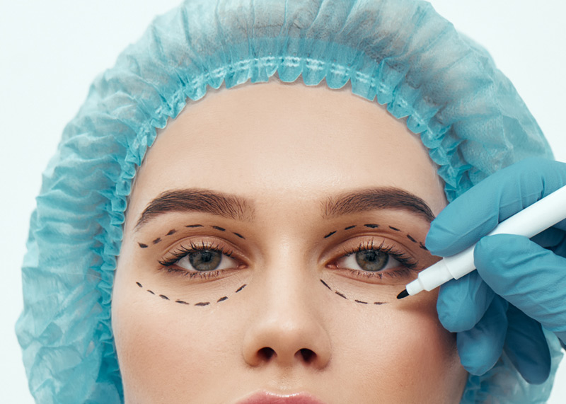 Blefaroplastia