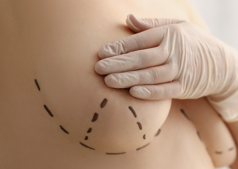 Mamoplastia Redutora