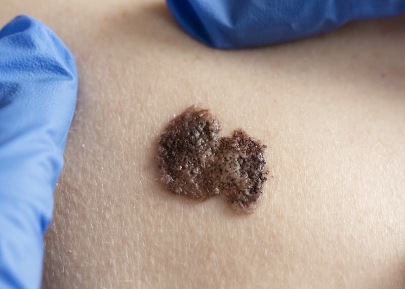 Câncer de Pele - Melanoma