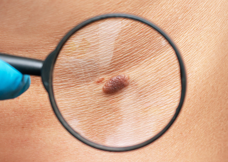 Câncer de Pele - Não melanoma