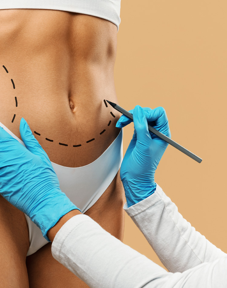 Irregularidade e Insatisfação com a Lipoaspiração