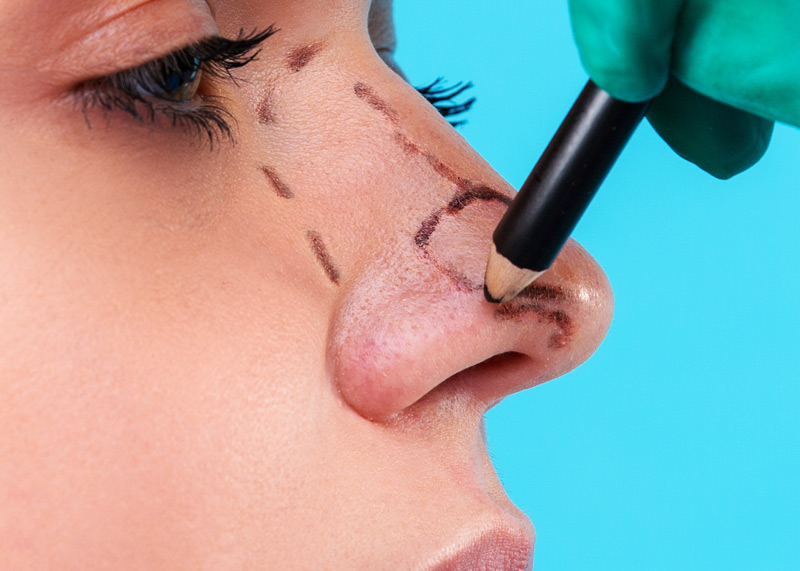 Rinoplastia