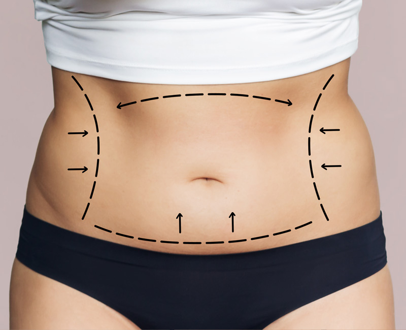 Abdominoplastia