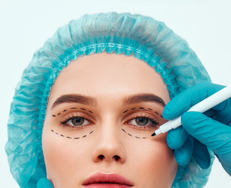 Blefaroplastia