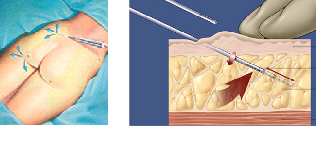 Lipoaspiração, Dr. Fernando Araujo, Cirurgião Plástico em Aracaju